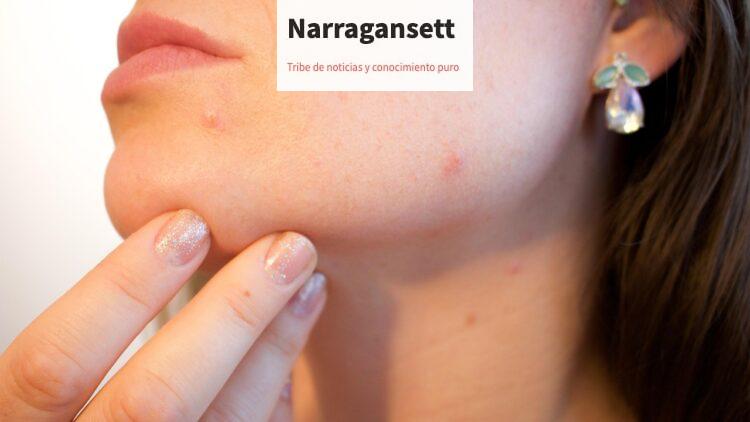Cómo diferenciar entre acné hormonal, bacteriano y fúngico
