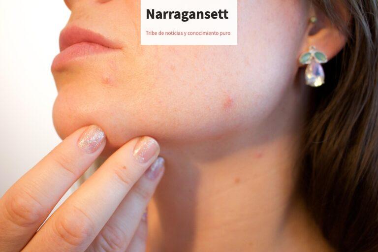Cómo diferenciar entre acné hormonal, bacteriano y fúngico