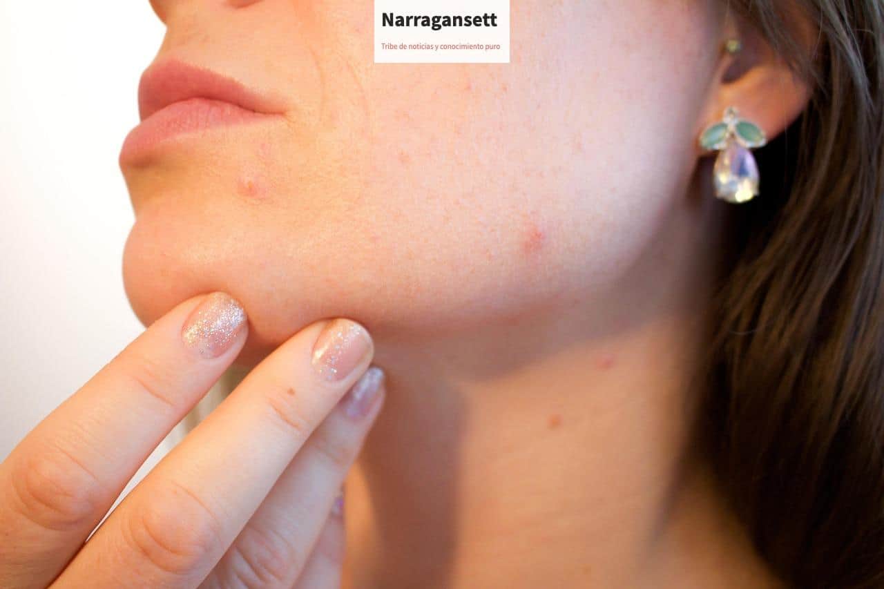 Cómo diferenciar entre acné hormonal, bacteriano y fúngico