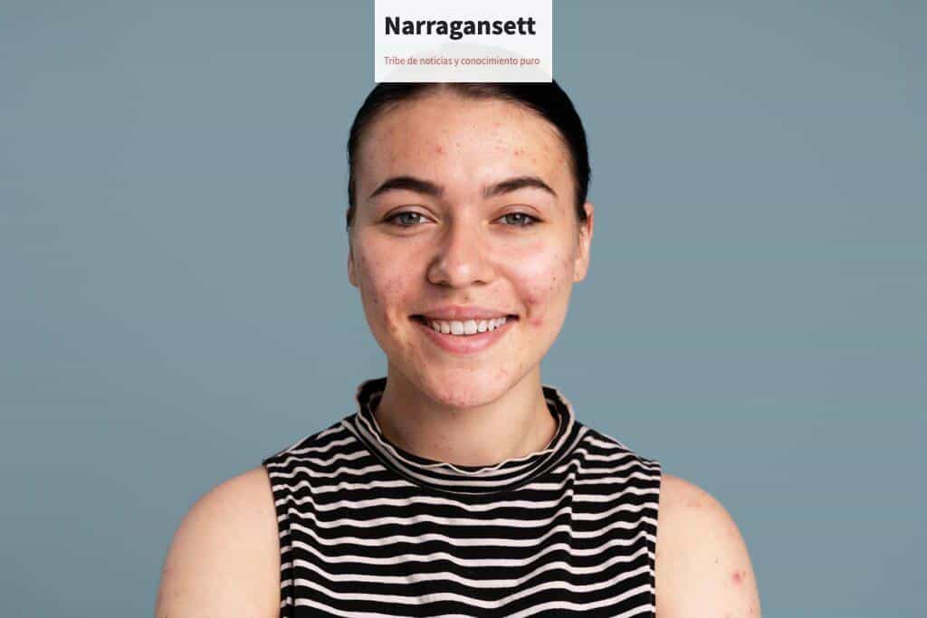 diferenciar entre acné hormonal, bacteriano y fúngico